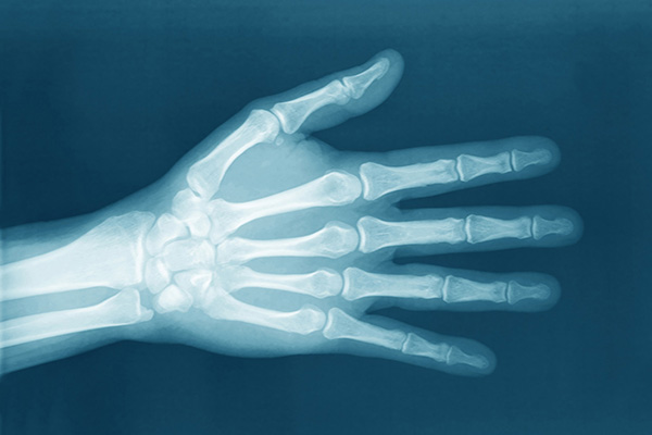 Illustration Favoriser le bon usage des médicaments en cas de polyarthrite rhumatoïde